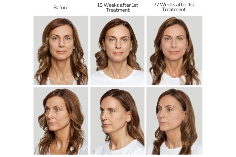 Why This Sculptra Supplier Stands Out
